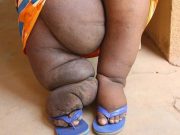 Maladies tropicales négligées et pourtant elles aveuglent, mutilent, défigurent…