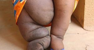 Maladies tropicales négligées et pourtant elles aveuglent, mutilent, défigurent…