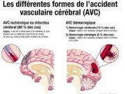 AVC : sensibilisation sur la prévention et le traitement