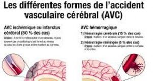 AVC : sensibilisation sur la prévention et le traitement