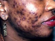 Peut-on résoudre le problème de la dépigmentation avec une loi?