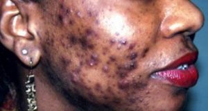 Peut-on résoudre le problème de la dépigmentation avec une loi?