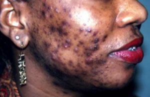 Peut-on résoudre le problème de la dépigmentation avec une loi?