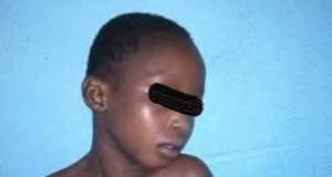 Burkina: une fillette de trois ans décédée suite à un viol