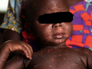 Afrique: la rougeole, une maladie en explosion sur le continent