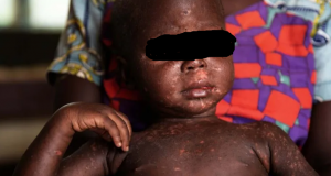 Afrique: la rougeole, une maladie en explosion sur le continent