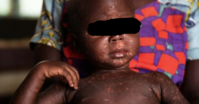 Afrique: la rougeole, une maladie en explosion sur le continent