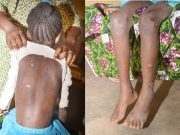 Ouagadougou: une fillette de huit ans victime de maltraitance