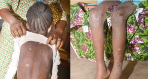 Ouagadougou: une fillette de huit ans victime de maltraitance