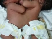 Ouagadougou: des bébés siamois séparés à l’hôpital de Bogodogo