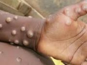 Mpox: l’OMS donne son autorisation à un test PCR pour le diagnostic de la maladie
