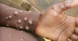 Mpox: l’OMS donne son autorisation à un test PCR pour le diagnostic de la maladie