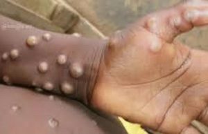 Variole du singe: l’Union africaine signale une «urgence de santé publique»
