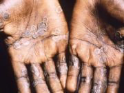 Le Mpox n’est pas le nouveau Covid-19 mais le monde doit lutter contre lui ensemble sur tous les continents (OMS)