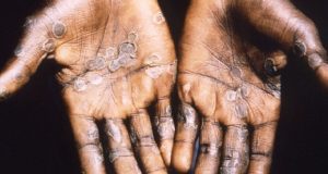 Le Mpox n’est pas le nouveau Covid-19 mais le monde doit lutter contre lui ensemble sur tous les continents (OMS)