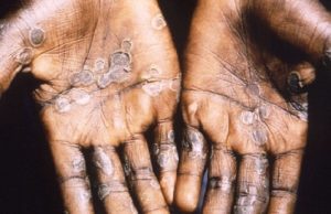 Le Mpox n’est pas le nouveau Covid-19 mais le monde doit lutter contre lui ensemble sur tous les continents (OMS)