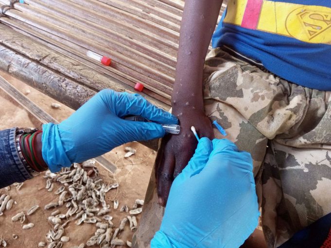 Mpox en Afrique : les enfants particulièrement menacés par la nouvelle variante (OMS/UNICEF)