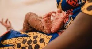 Mpox ou variole du singe: l’Afrique compte ses cas en attendant le vaccin!