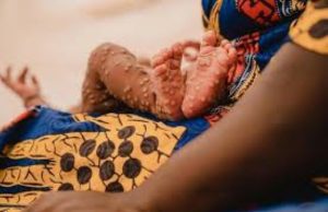 Mpox ou variole du singe: l’Afrique compte ses cas en attendant le vaccin!