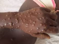 Guinée-Bissau: le mpox frappe pour la première fois, les enfants en première ligne