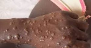 Epidémie de Mpox: l’OMS maintient l’alerte