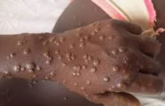 Guinée-Bissau: le mpox frappe pour la première fois, les enfants en première ligne