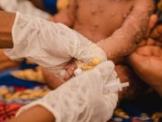 Mpox en Afrique : les enfants de moins de 5 ans représentent le tiers des cas au Burundi, selon l’UNICEF