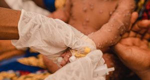 Mpox: une première livraison de vaccins attendue ce jeudi en RD Congo