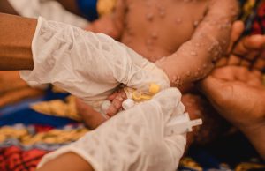 Mpox en Afrique : les enfants de moins de 5 ans représentent le tiers des cas au Burundi, selon l’UNICEF