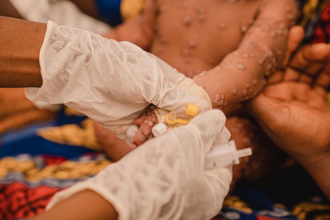Mpox: une première livraison de vaccins attendue ce jeudi en RD Congo