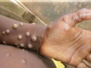 Kenya: 19 morts en trois mois, la mpox gagne du terrain