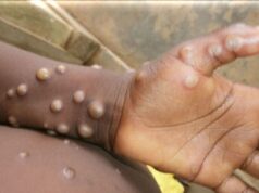 Kenya: 19 morts en trois mois, la mpox gagne du terrain