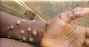 Kenya: 19 morts en trois mois, la mpox gagne du terrain