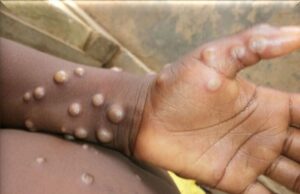 Kenya: 19 morts en trois mois, la mpox gagne du terrain